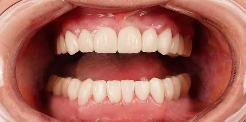 before-after-dental-implant-1-2