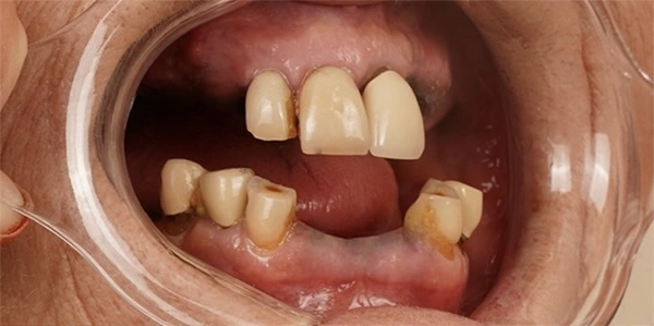 before-after-dental-implant-2-1