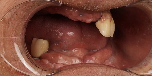 before-after-dental-implant-3-1